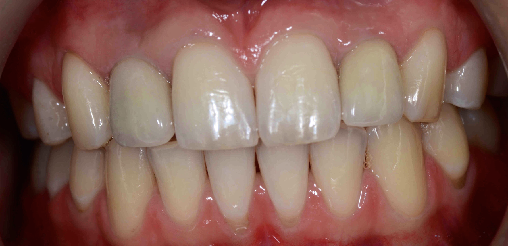 Dental Implants in Nottingham The Campbell Clinic